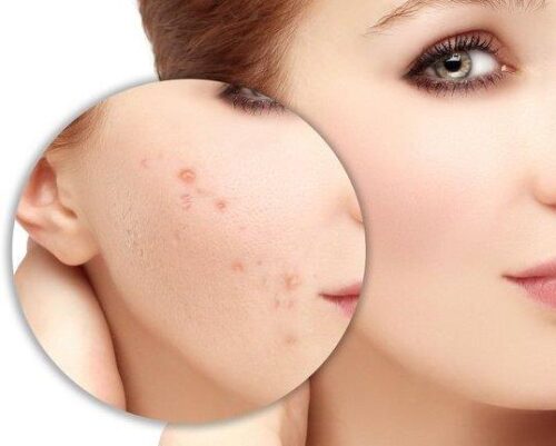 PHÂN PHỐI SỈ VIÊN UỐNG GIẢM MỤN CHÍNH HÃNG