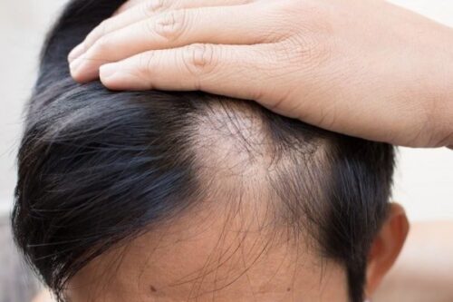 10 Nguyên nhân rụng tóc ở nam giới, cách điều trị và phòng tránh