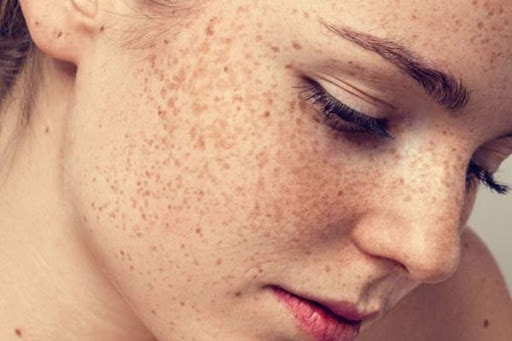 Cách phân biệt nám và tàn nhang trên da