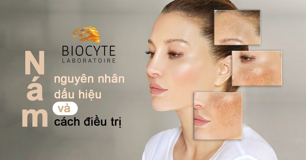 Nám da: nguyên nhân, dấu hiệu và cách điều trị hiệu quả