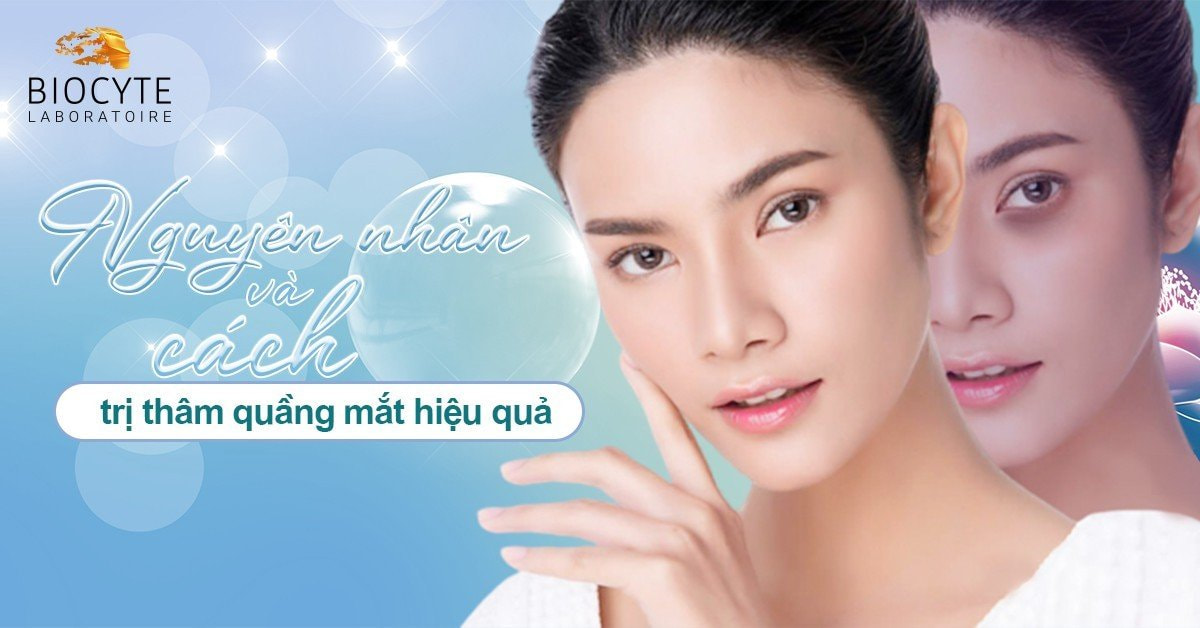 Nguyên nhân và cách trị thâm quầng mắt