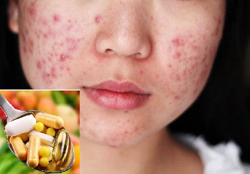 Tác dụng của việc uống thuốc trị mụn