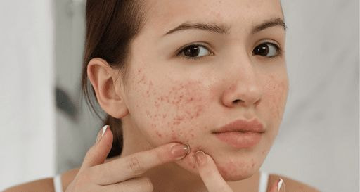 Nguyên nhân gây nên tình trạng mụn