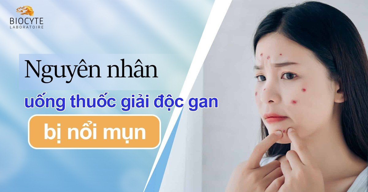 Nguyên nhân uống thuốc giải độc gan bị nổi mụn