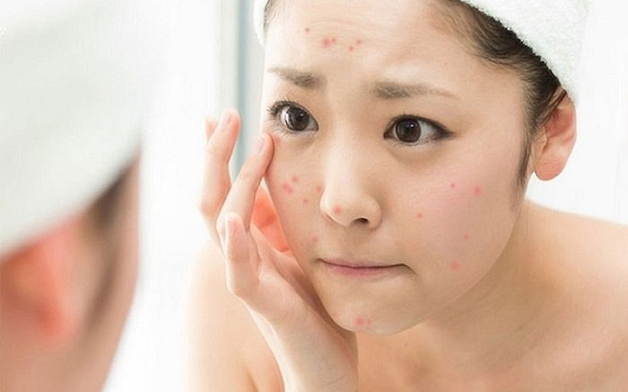 Thiếu kẽm gây nổi mụn và các vấn đề về da