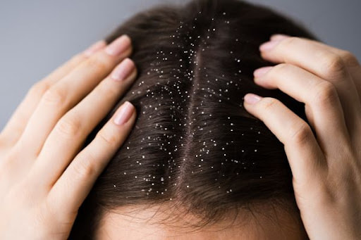 Da đầu có nấm là nguyên nhân gây rụng tóc ở nữ giới