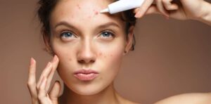 Skincare sai cách dẫn đến việc da bị mụn 