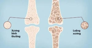 Loãng Xương – Kẻ Thù Âm Thầm Ở Tuổi Trung Niên