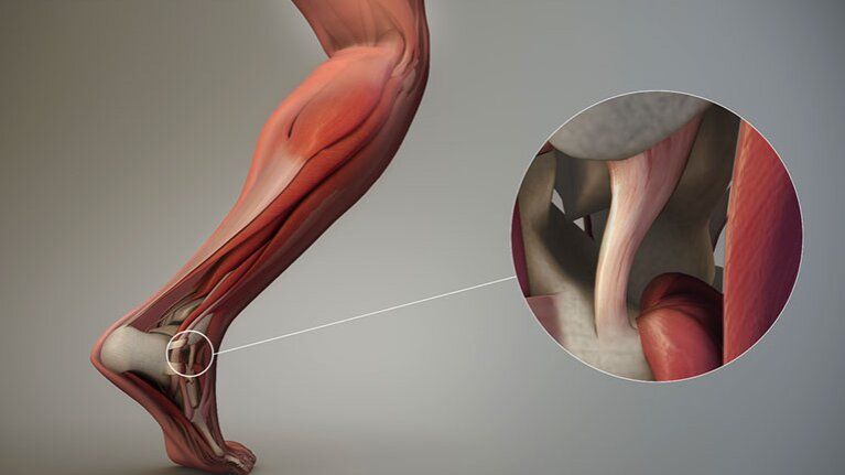 Những Chấn Thương Gân Và Dây Chằng Phổ Biến Nhất
