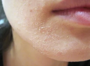 da khô nứt nẻ mùa đông